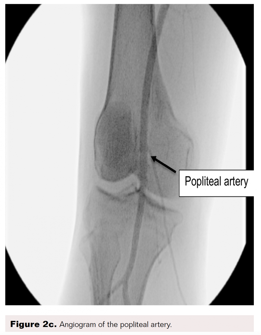 PedalPlantar Loop in Lower Extremity Angiographic Interventions